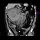 Retroperitoneal hematoma, active bleeding, revision, drain, edema of small bowel: CT - Computed tomography